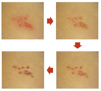 대상포진 피부병변 변화양상 (출처 서울대병원)